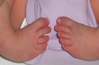 ജില്ലയിലെ 3 ക്ലബ് ഫൂട്ട് ക്ലിനിക്കുകളിൽ ഒന്ന്  മുവാറ്റുപുഴ ജനറൽ ആശുപത്രിയിലും.