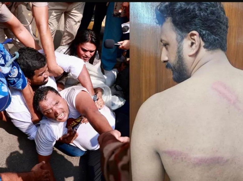 നീറ്റ് പരീക്ഷ ക്രമക്കേട് ഡൽഹിയിൽ യൂത്ത് കോൺഗ്രസ് പ്രതിഷേധം ഇരമ്പി ; ലാത്തിചാർജിൽ രാഹുൽ മാങ്കൂട്ടത്തിന് ഗുരതര പരിക്ക്.